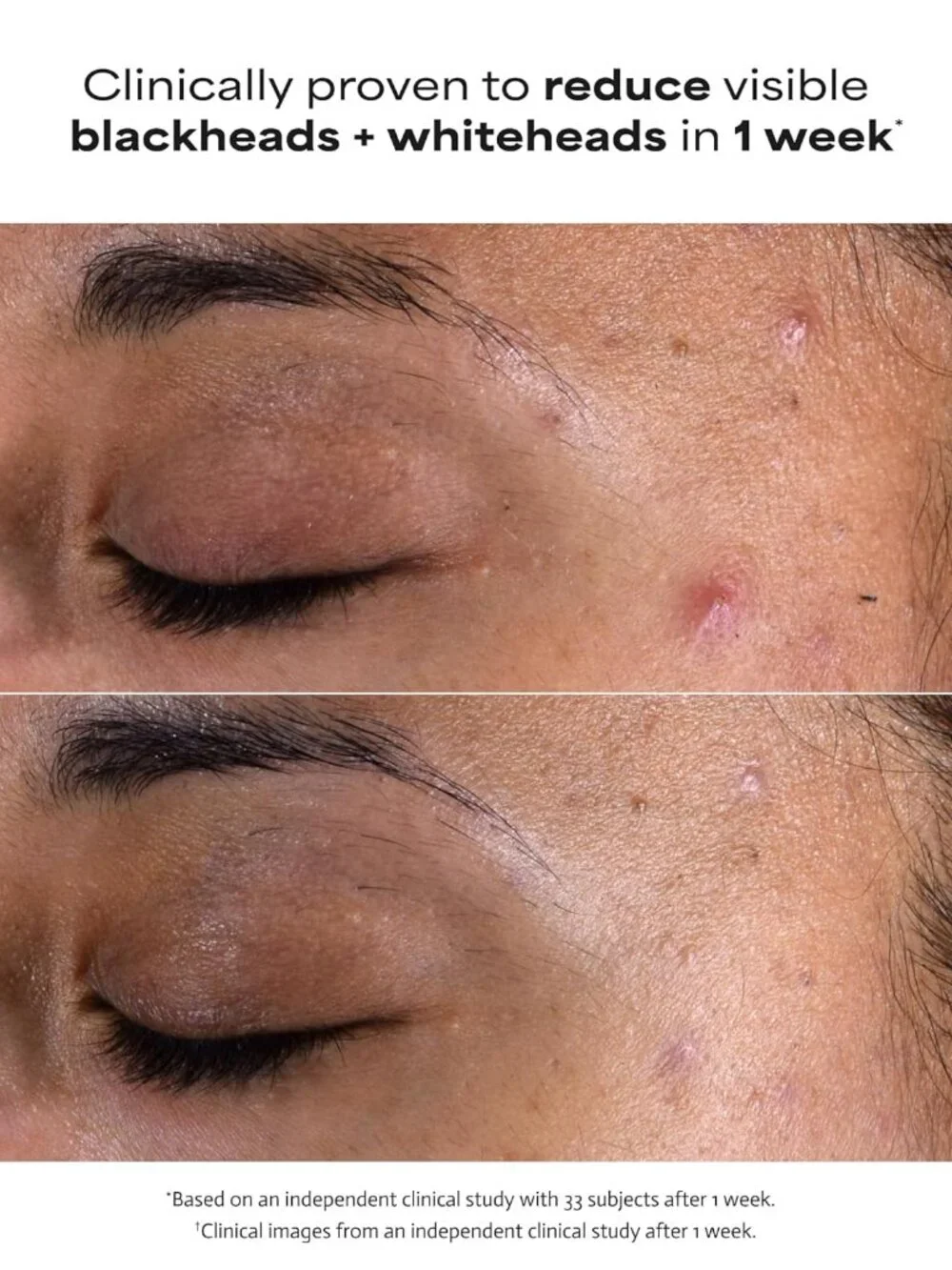 Paula's Choice SKIN PERFECTING 2% BHA Liquid Leave-On Exfoliant